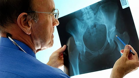 هشاشة العظام