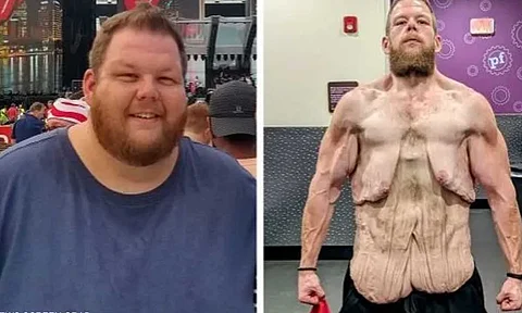 «لا أريد أن أموت صغيرًا».. صورة صادمة لرجل خسر 152 كيلوجرامًا من وزنه