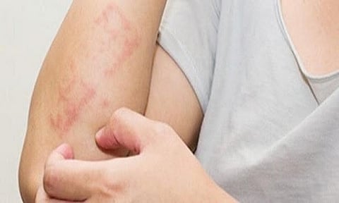 حساسية الجلوتين (السيلياك)