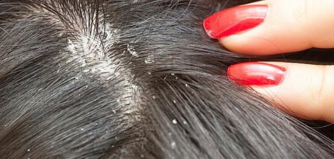 في 4 خطوات .. كيف تتخلص من القمل؟