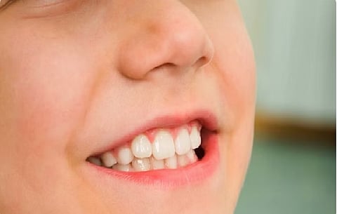 أسنان الأطفال