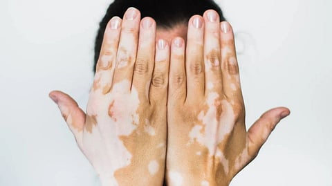 أنواع مرض البهاق