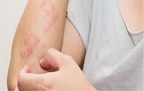 مرض «السيلياك