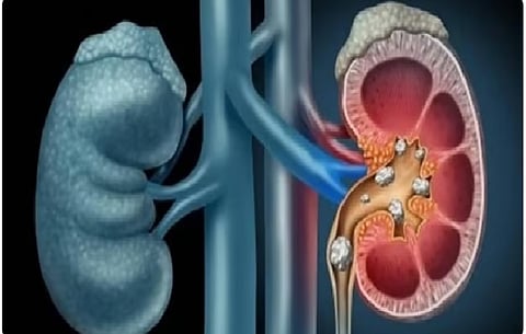 حصوات الكلى