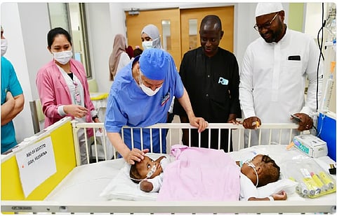 عملية فصل «حسنة وحسينة»