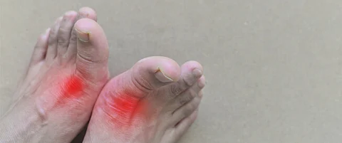 النقرس