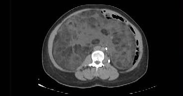 «سعود الطبية» تنهي معاناة ثلاثينية من ورم نادر بوزن تسعة كجم