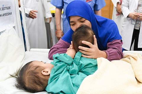 بدء عملية فصل التوأم السيامي الفلبيني "أكيزا وعائشة"