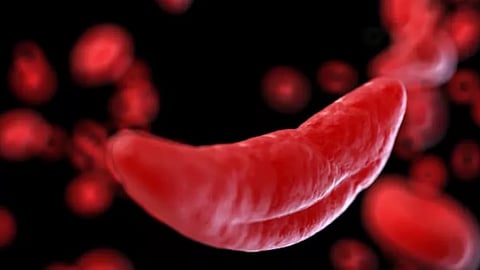 «فهد الطبية» توضّح أعراض فقر الدم المنجلي وأسبابه