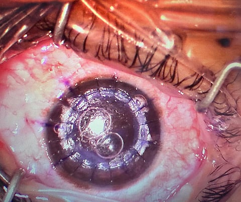 «فريق العيون» بتجمع جازان الصحي ينجح في ترميم وزراعة جزئية لقرنية فتاة ثلاثينية ومسن سبعيني