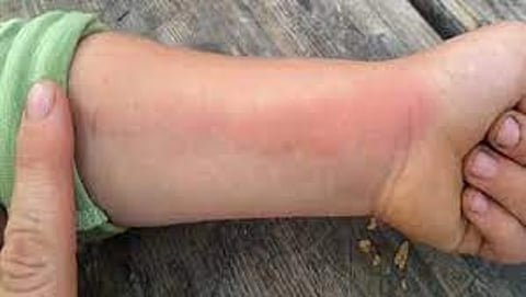 «سعود الطبية» توضح أعراض تسمم الدم الجرثومي وطرق الوقاية منه