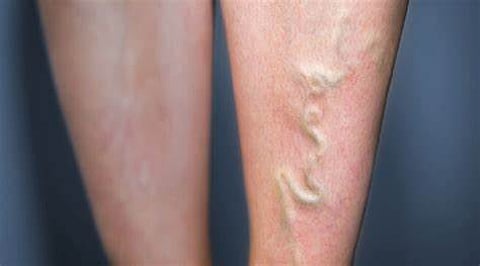 «فهد الطبية» توضّح أسباب تخثر الأوردة وطرق الوقاية منه