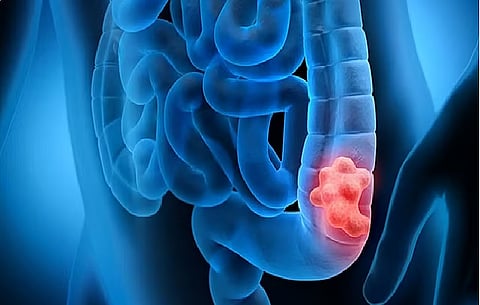 فحص للدم يكشف سرطان القولون بدقة 95% في مراحله المبكرة