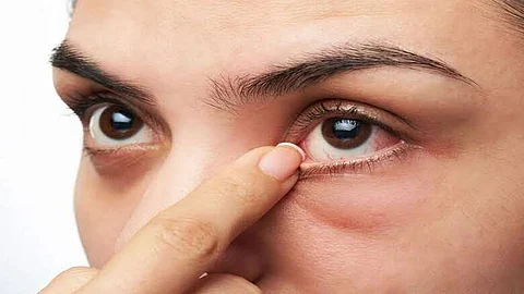 تظهر في العين.. تحذير من أكبر علامة على ارتفاع الكوليسترول في الدم