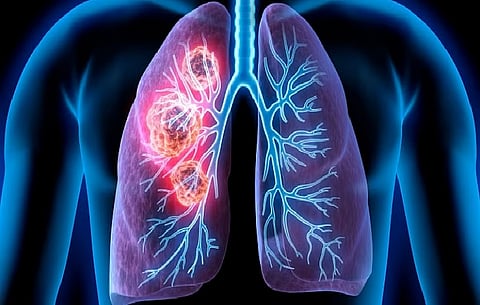 تجمع القصيم الصحي يوضح أعراض سرطان الرئة