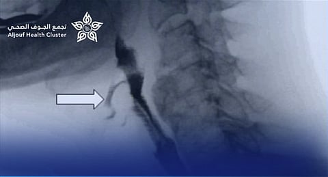 نجاح توسعة مريء لطفل بالمنظار دون تدخل جراحي في «تخصصي الجوف»
