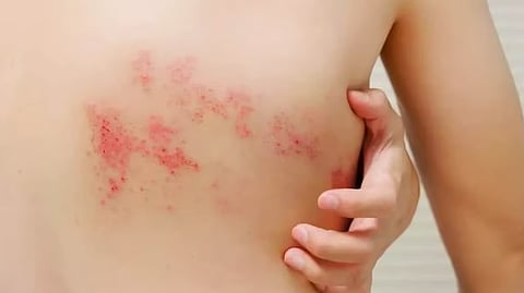 استشاري: التهاب فيروس الحزام الناري يسبب آلامًا شديدة للأعصاب