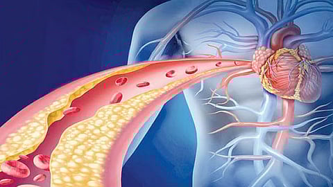 خبيرة تحدد سبب مرض كوليسترول الدم العائلي المتماثل