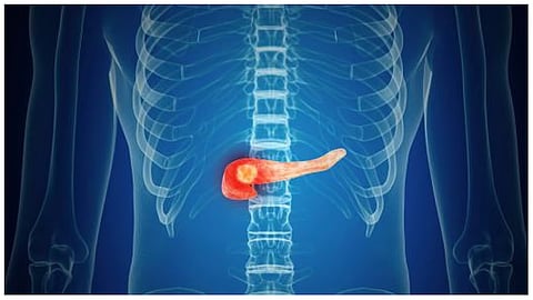 فهد الطبية توضح أعراض سرطان البنكرياس وطرق علاجه