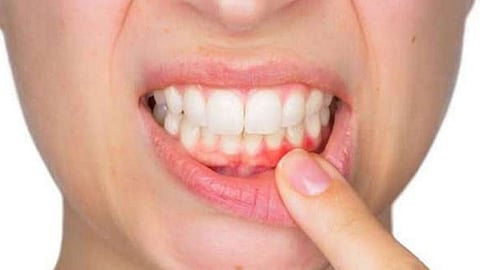 نزيف اللثة ينذر بالتهاب دواعم السن واحمرار وتورم