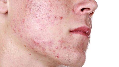 4 وصفات طبيعية للتخلص من حب الشباب