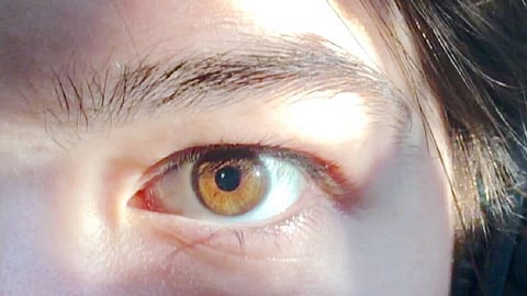 أسباب وأعراض التهاب قزحية العين.. وطرق علاجها