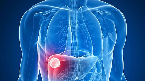 استشاري: 6 نصائح للوقاية من أورام وسرطان الكبد