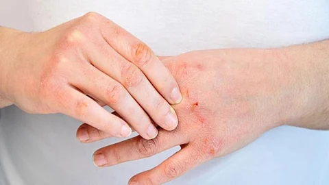 هل الصدفية مرض معدِ وينتقل بالمخالطة؟ استشاري يجيب