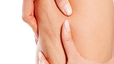 أفضل الطرق لمحاربة السيلوليت والتخلص منه