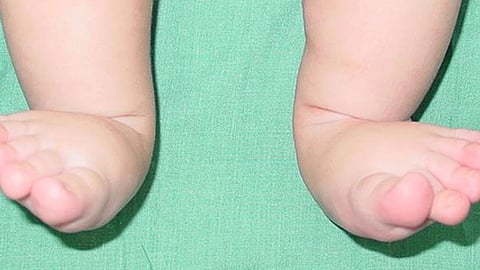 تشوهات الأقدام لدى الأطفال.. متى تستلزم استشارة الطبيب؟