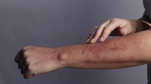 الكشف عن أعراض جلدية تشير للإصابة بكورونا