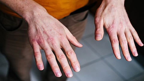 استشاري جلدية: 6 قواعد لاستحمام أصحاب الأكزيما وجفاف الجلد خلال الشتاء