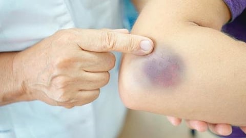 ما أسباب ظهور بقع زرقاء على الجسم؟