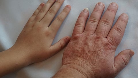 تعرف على أسباب ضخامة الأطراف وطرق علاجها