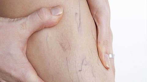 استشاري يكشف عن أسباب ظهور دوالي الساقين