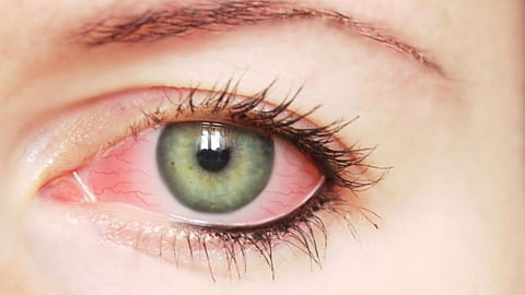 التهاب ملتحمة العين