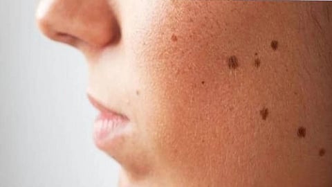 إخصائي يحذر: بعض الشامات يمكن أن تكون قاتلة