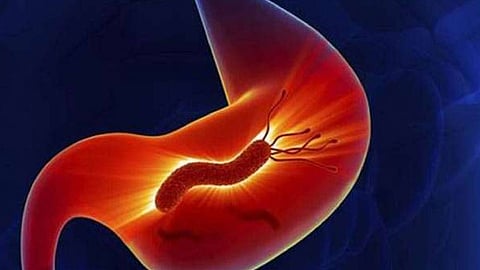 مستشفى الملك فيصل التخصصية يوضّح 6 أعراض تدل على الإصابة بجرثومة المعدة