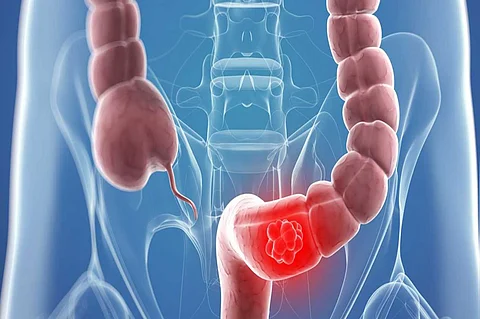 4 أعراض أساسية للإصابة بسرطان الأمعاء