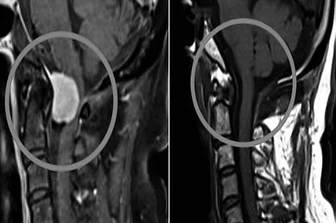 إنقاذ خمسيني من ورم في منطقة حساسة بالدماغ