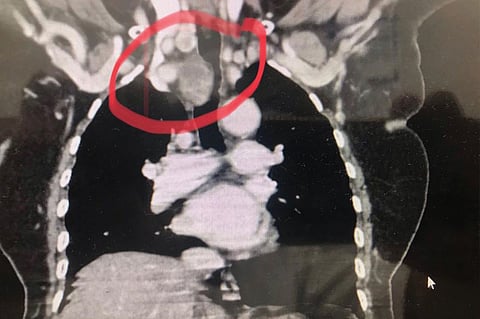 فريق طبي بمستشفى الملك فهد المركزي ينهي معاناة مسنة بجازان