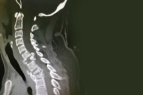 بالصور.. «أطباء بريدة» ينقذون حياة شابة بعد حادث أليم