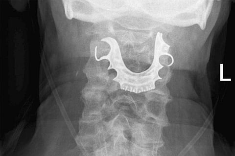 بعد واقعة مثيرة.. نصيحة طبية بخصوص أطقم الأسنان والجراحة