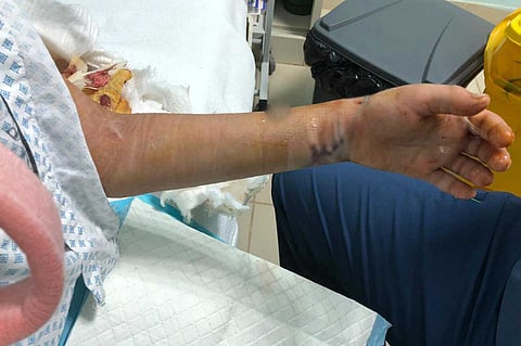 بالصور.. عملية معقدة لترميم كسور طفل بمستشفى المندق العام