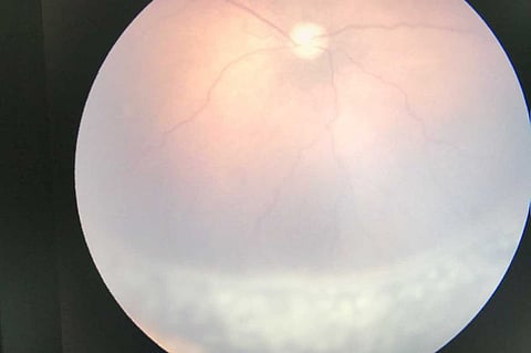 بالصور.. عملية نوعية لعلاج عيون الرضيعة «خديجة» بالطائف