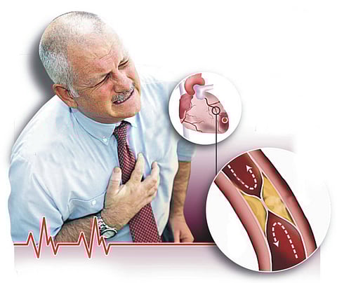 النمر: تأخير وجبة العشاء يُزيد احتمالية الإصابة بجلطة القلب الثانية