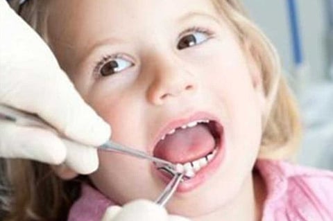 أعراض «الأسنان الطباشيرية» وطرق علاجه