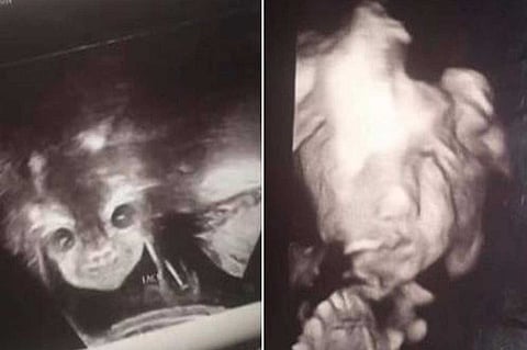 «الجنين الشيطان» يثير رعب والديه وضجة حول العالم