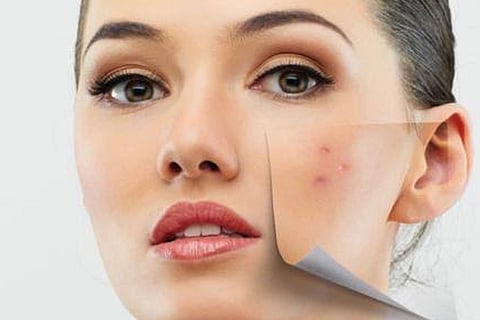 وصفة متوازنة للحفاظ على نضارة البشرة.. وعلاج حَبِّ الشباب