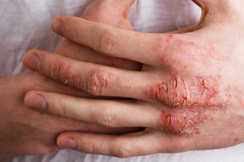 8 مؤشرات تدل على الإصابة بالأكزيما